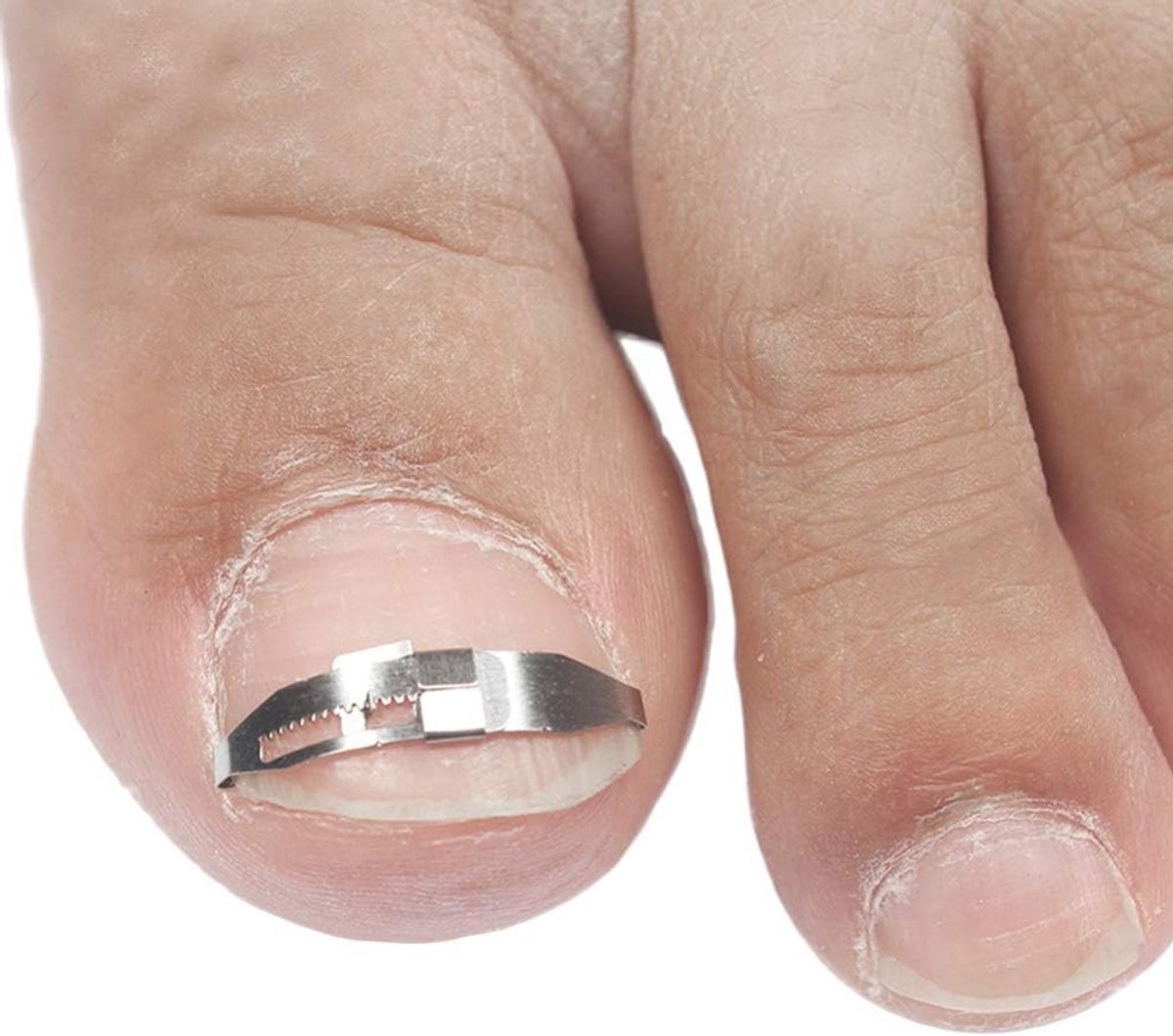 Ingrown Toenail Pedicure Tool voor Correctie van Dikke Teennagels en Paronychia Behandeling met RVS Klem en Curved Clip