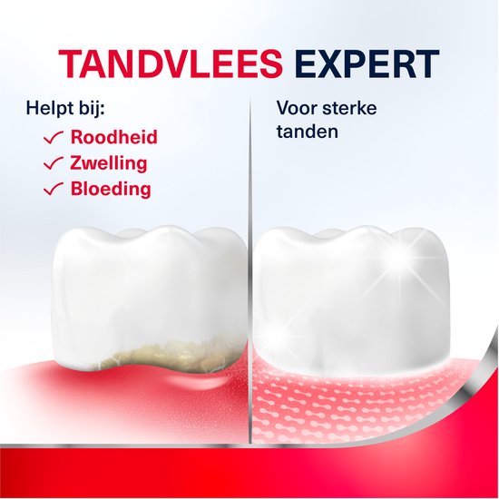 Vergelijking van tandvlees: ongezond met roodheid, zwelling, bloeding en gezond met sterke tanden.