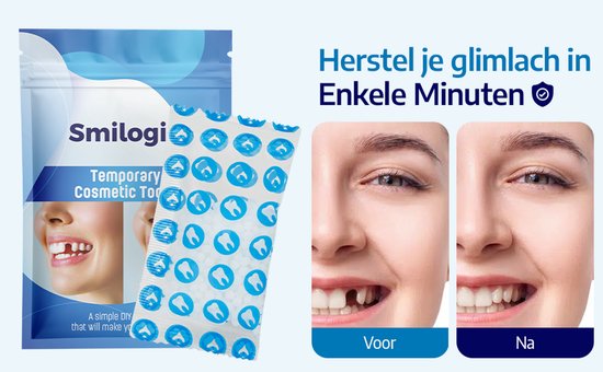 Smilogic tijdelijke cosmetische tand. Voor- en nafoto's van een glimlach met een ontbrekende tand.