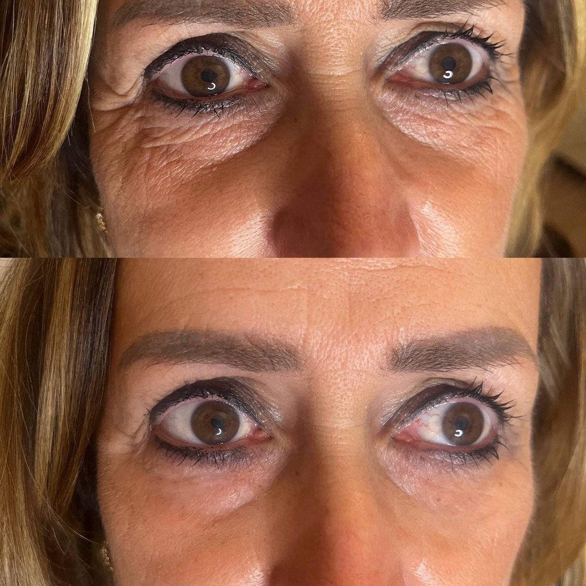 Goedkoopste Age Reversist Botox in een zakje! Anti rimpel! Direct effect tot wel 8 uur lang!