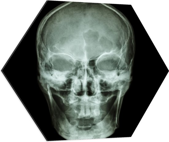 Dibond Hexagon - Röntgenfoto van Mensenschedel - 70x60.9 cm Foto op Hexagon (Met Ophangsysteem)