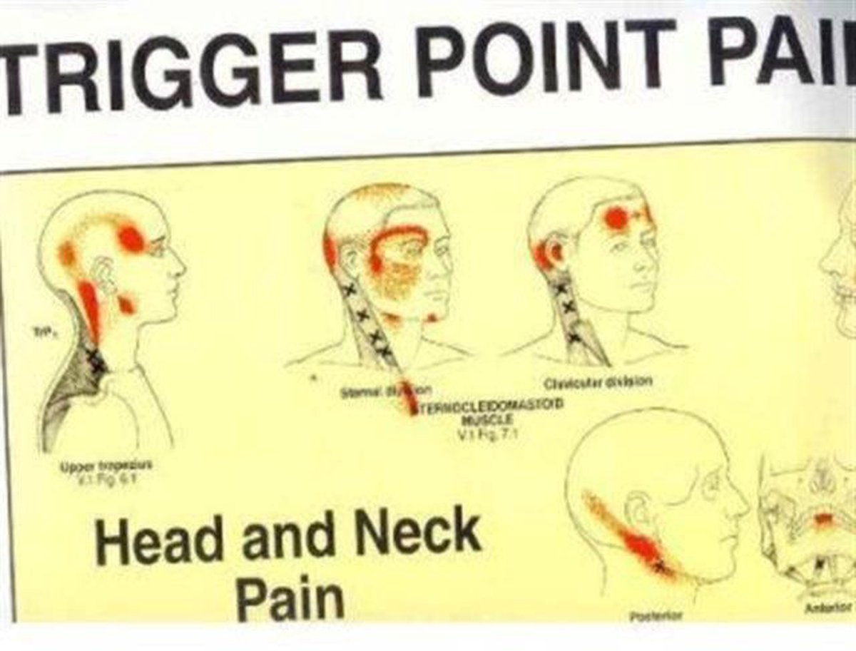 Travell and Simons' Trigger Point Pain Patterns Wall Charts