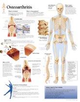 Osteoarthritis Laminated Poster