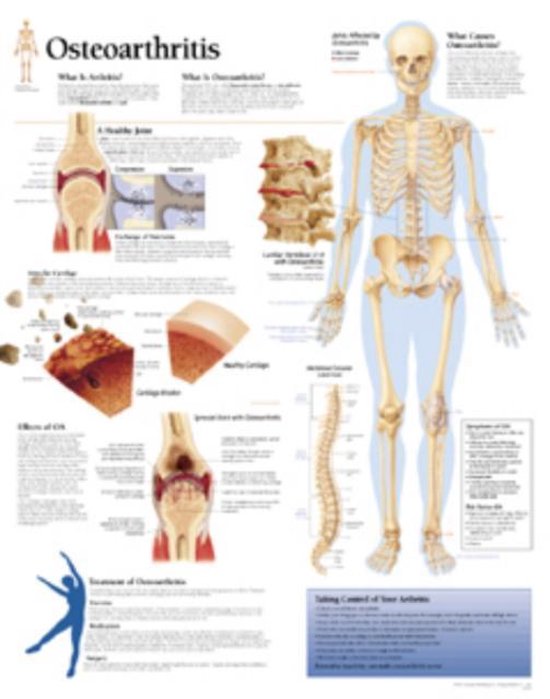 Foto: Osteoarthritis laminated poster