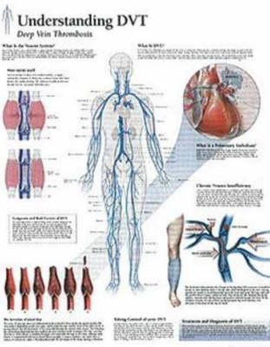 Foto: Understanding dvt laminated poster