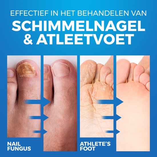 Voor en na foto's van schimmelnagel en voetschimmel behandeld met Imperial Feet.