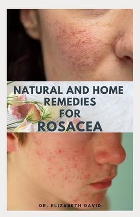 Natural and Home Remedies for Rosacea - cover