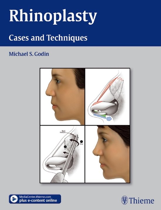 Rhinoplasty - cover