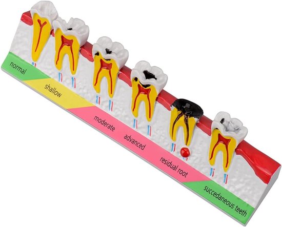 Tandbederf Model - Tand Anatomie - Onderwijs & Demonstratie - Gedetailleerde Structuren - 15 x 4 x 4 cm - Kleurrijk — afbeelding 5