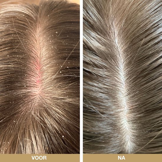 Split image showing a dry, flaky scalp with redness ('VOOR' - Before) and a healthy, clean scalp ('NA' - After).