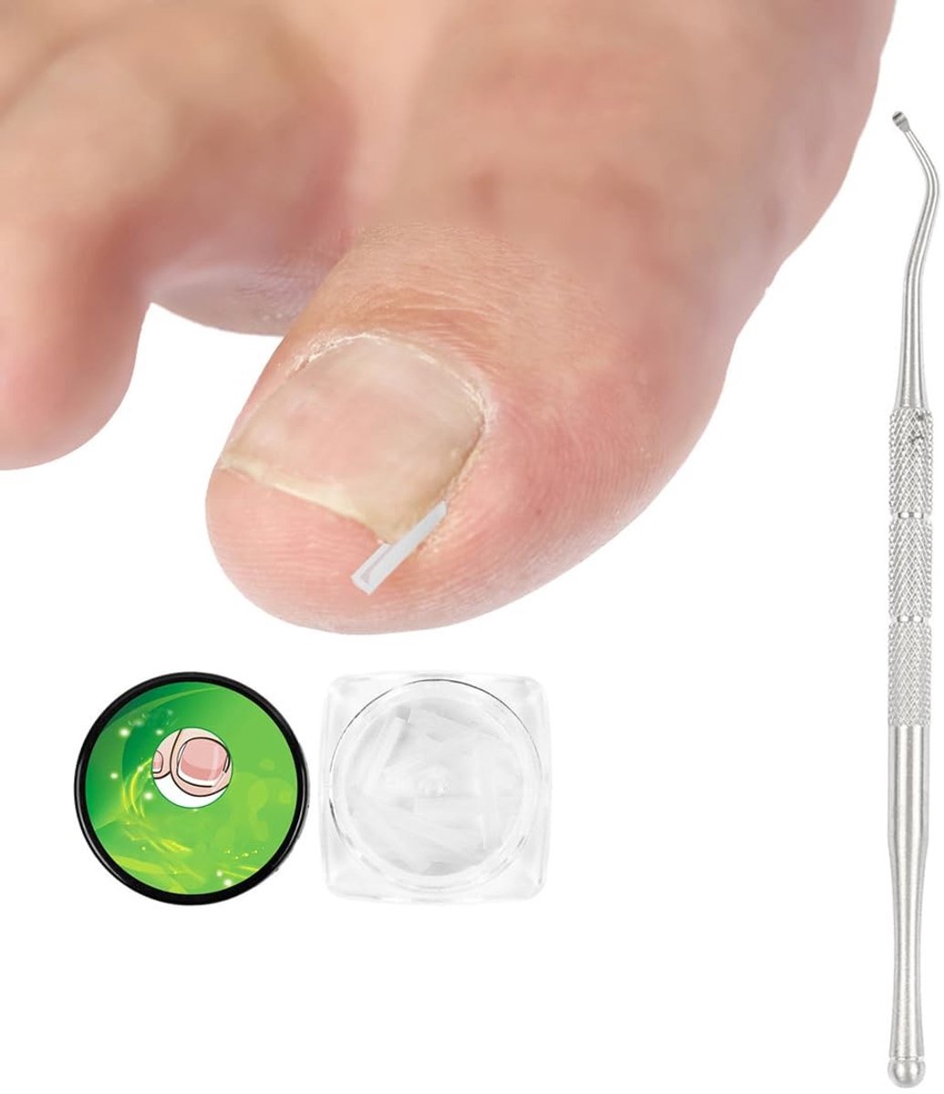 Dailygoods- Correctieset 50 Stuks - Pijnloze Nagellifter - Gereedschapsset voor Ingrowende Teennagels - Wetenschappelijke Behandeling - Verlichting van Pijn en Roodheid - Nagelcorrectie