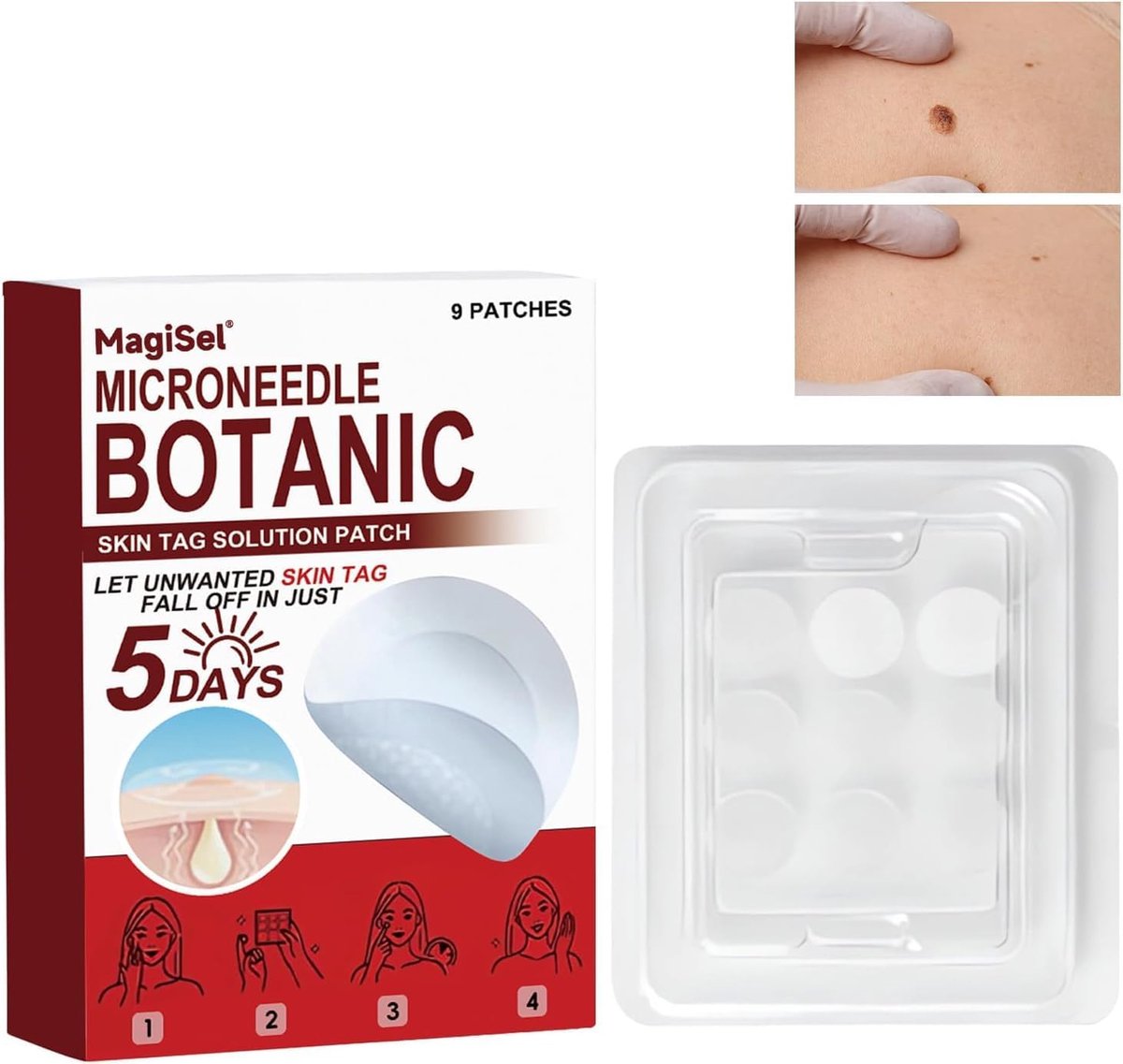 Botanisch Micronaalden voor het verwijderen van huidaanhangsels, professionele nano-puistjespleister, voor - ShopVlot