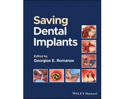 Saving Dental Implants