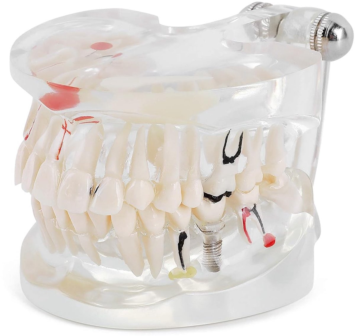 aladdien - Dental Implant Study Model - Volwassen Tandmodel - Realistisch Onderwijsmodel - Transparant - Verwijderbare Tanden - Ideaal voor Tandheel...