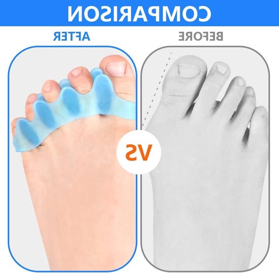Siliconen Tussenstukjes voor Tenen - Hallux Valgus Correctie, Comfortabele Tussenruimte voor Alle Tenen, Unisex Design — afbeelding 3