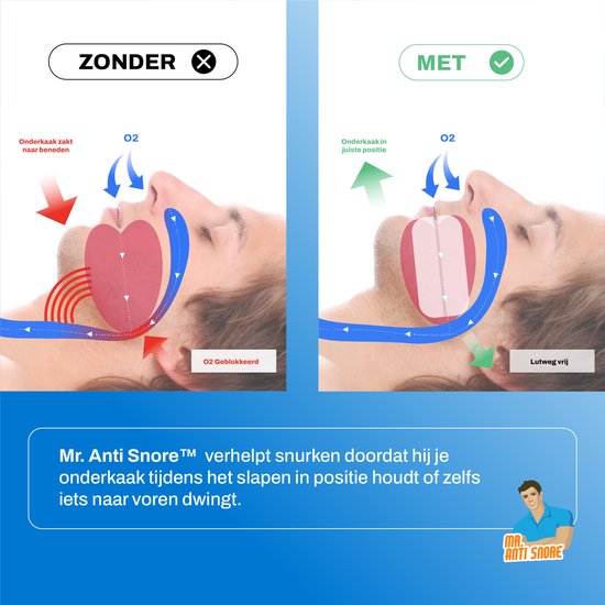 Diagram dat laat zien hoe Mr. Anti Snore snurken voorkomt door de onderkaak in positie te houden.