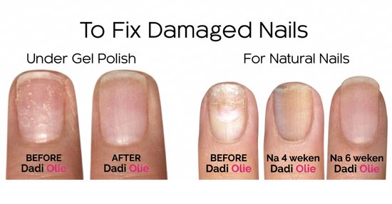 Voor en na foto's van nagels die behandeld zijn met Dadi'Olie. De afbeeldingen tonen droge, beschadigde nagels 'voor' en verbeterde nagels 'na'.