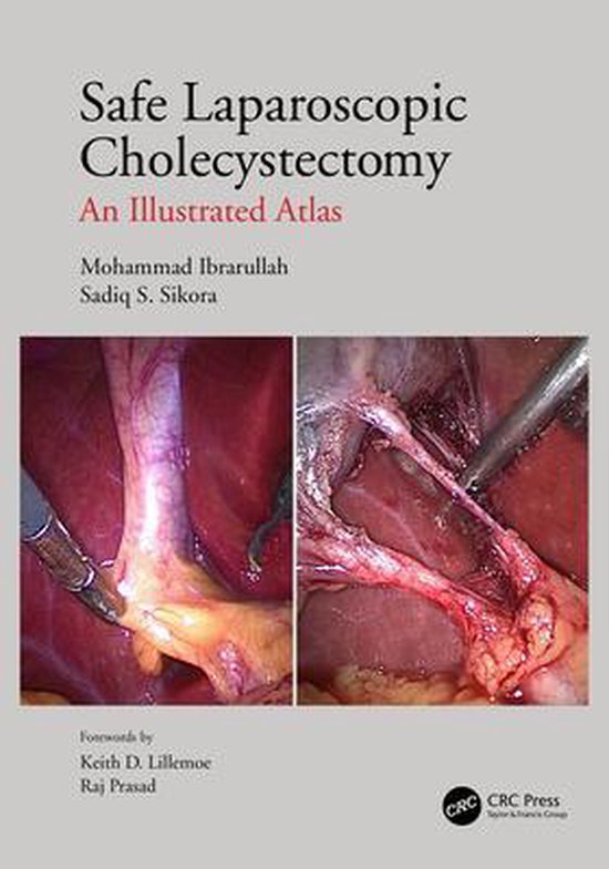 Safe Laparoscopic Cholecystectomy - cover