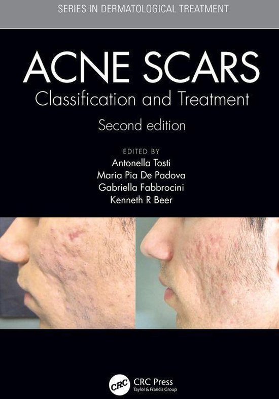 Series in Dermatological Treatment - Acne Scars - cover
