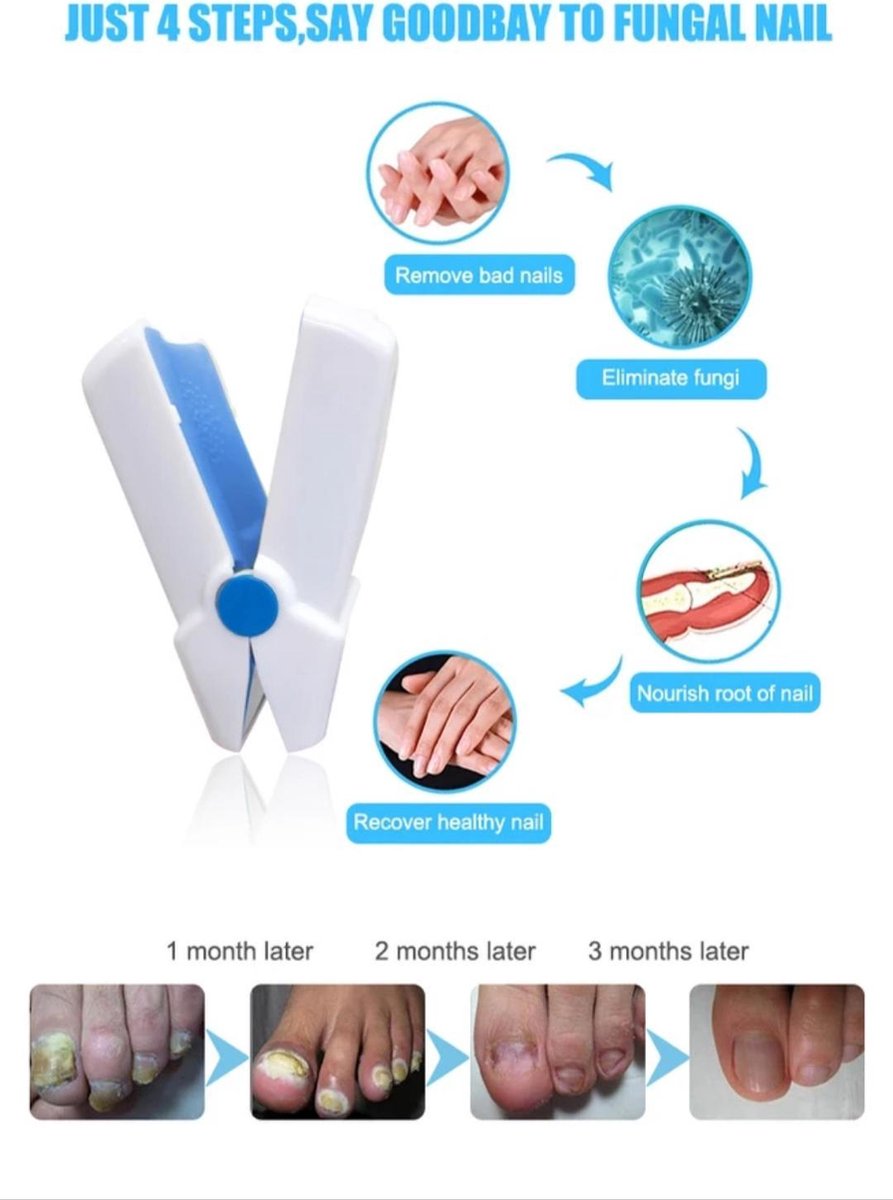 ON Home Anti Kalknagel Laser Nail Cleaning Laser Device Anti