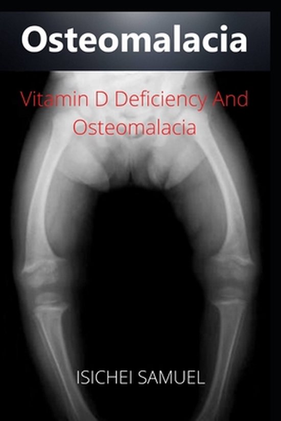 Osteomalacia Vitamin D Deficiency And Osteomalacia 9798420444733