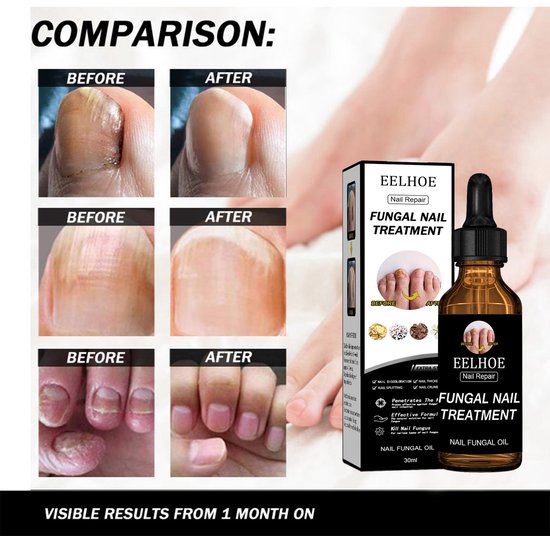 EELHOE Nagel Herstel Oplossing – Versterkend, Hydraterend & Beschermend – Glycerine, Hydrolyzed Tarweproteïne & Keratine – Nail Care 30 ml
