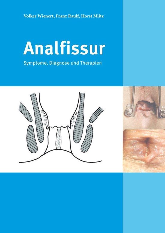 Analfissur (ebook), Franz Raulf | 9783844227826 | Boeken | bol