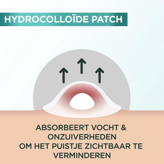 Close-up illustratie van een hydrocolloïde patch die vocht en onzuiverheden absorbeert van een puistje.
