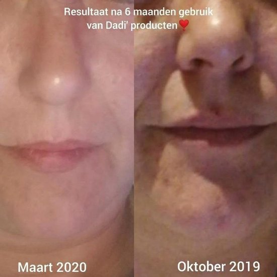 Vergelijking van monden in maart 2020 en oktober 2019, na 6 maanden gebruik van Dadi producten. De huid ziet er gladder uit in oktober 2019.