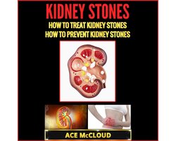 Kidney Stones: How To Treat Kidney Stones: How To Prevent Kidney Stones