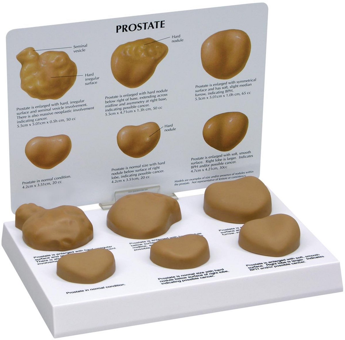 Anatomisch Prostaatmodel voor Medische Educatie en Patiëntvoorlichting