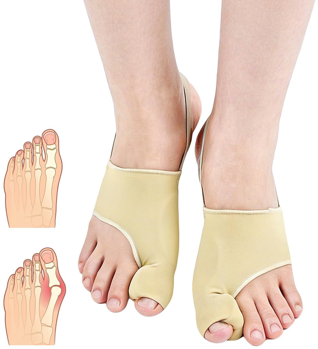 2 x Hallux Valgus corrector voor dames en heren, grote tenenslippers, zacht, ademend, voor dag en nacht, eenheidsmaat, hallux valgus-correctie, teenspreider, spalk, teenspreider, huidskleur