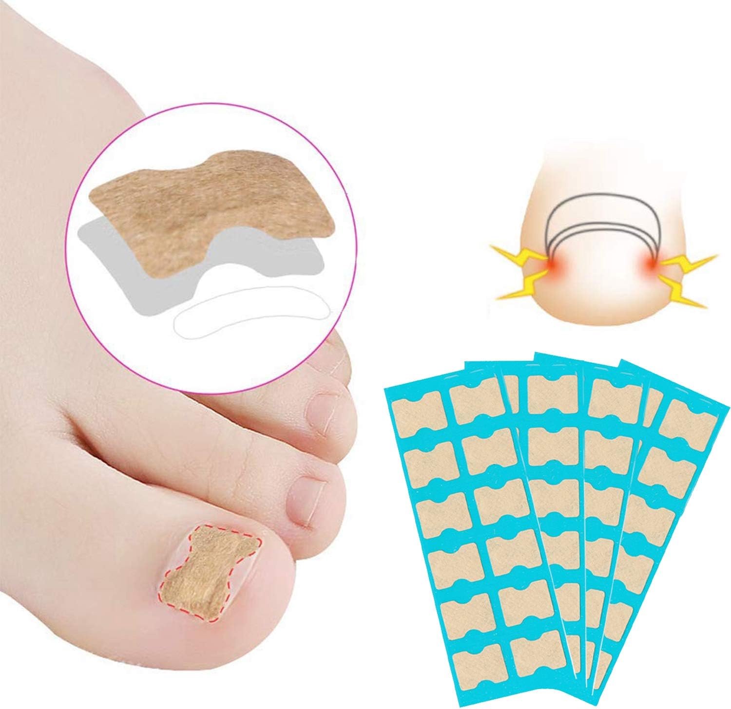 Teennagelcorrectiepatch, 48 stuks teennagelpatch, corrector pedicure gereedschap, correctie-stickers, teen-nagels, ingegroeide teennagels, correctiepatch, paronychie corrector