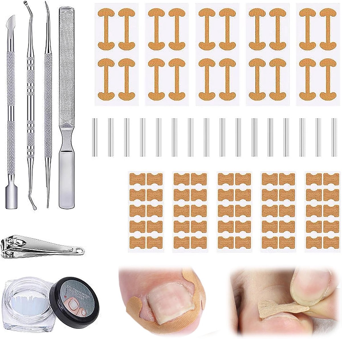 Pedicure Set of 105 Ingrown Toenails with Nail Clip and Correction Patch, Professional Tool Set for Nail Care and Pain - ShopVlot