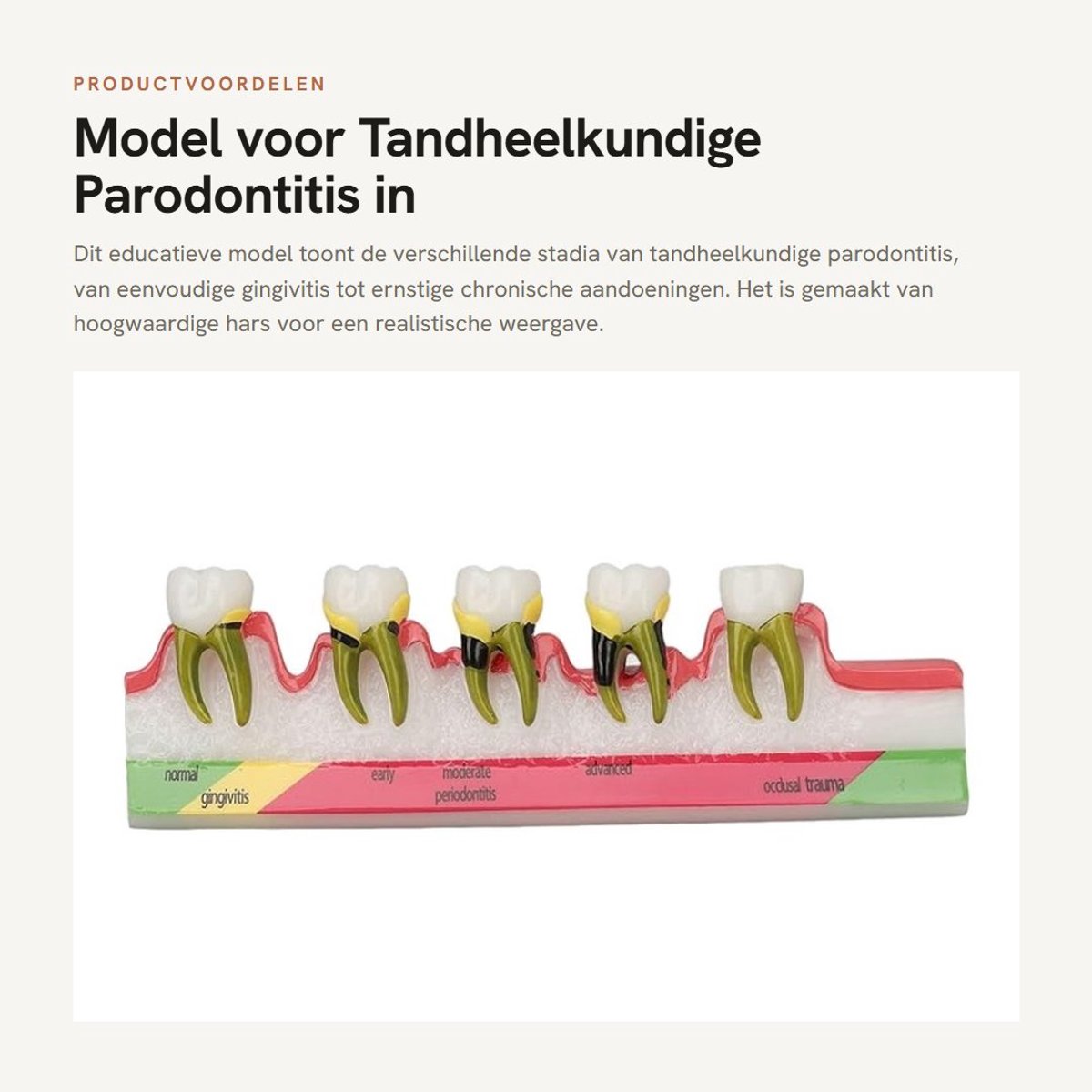 Dailygoods- Parodontitis Model - Hars - Weergavemodel - Tandheelkundige Aandoeningen - Gingivitis - Chronische Parodontitis - Duidelijke Weergave - Tandheelkundig Model