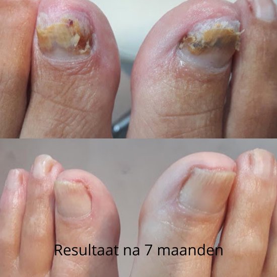 Voor en na foto's van beschadigde teennagels, die na 7 maanden behandeling met Dadi Oil aanzienlijk zijn verbeterd.