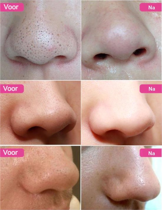 neutrale desinfecteren plafond Sace Lady poriën neus strips | Anti mee-eters | bol.com