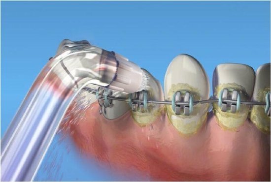 4 Embouts Orthodontie Pour Hydropulseur Waterpik - Compatible Appareils Dentaires, Transparent