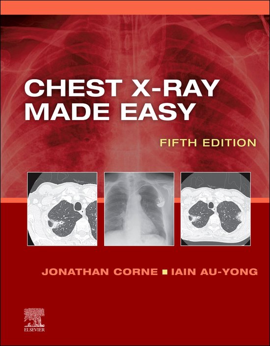 Made Easy Chest XRay Made Easy EBook (ebook), Iain AuYong, Ma