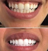 GleamWhite Whitestrips - Tanden Bleken - Mooie Resultaten - Geen gevoelige tanden - Geen Peroxide