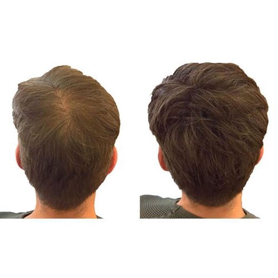 Vergelijking van mannelijk haar vóór en na toepassing van IMPERIO haarvezels, met de nadruk op verbeterde dichtheid.