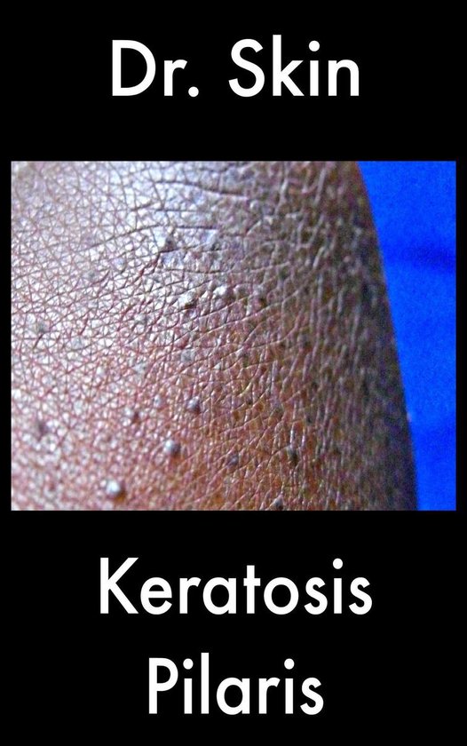 Keratosis Pilaris (ebook), Dr Skin 9781311590305 Boeken