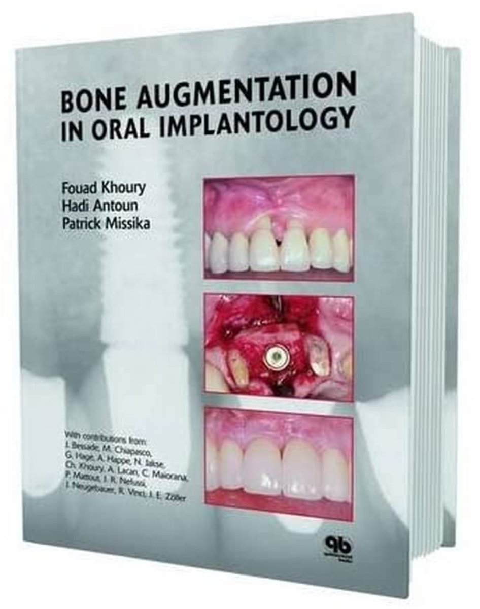 Dailygoods- Botaugmentatie in Mond Implantologie - Chirurgische Procedure - Tandheelkundige Behandeling - Implantaat Verbetering - Botopbouw - Professionele Zorg