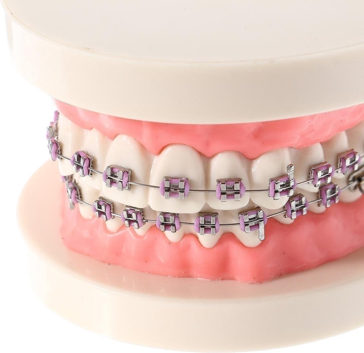 Tandheelkundige tanden malocclusie orthodontische model met volledige metalen beugels... |