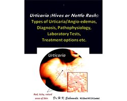Urticaria (Hives or Nettle Rash): Types of Urticaria/Angio-edemas, Diagnosis, Pathophysiology, Laboratory Tests, Treatment options etc.