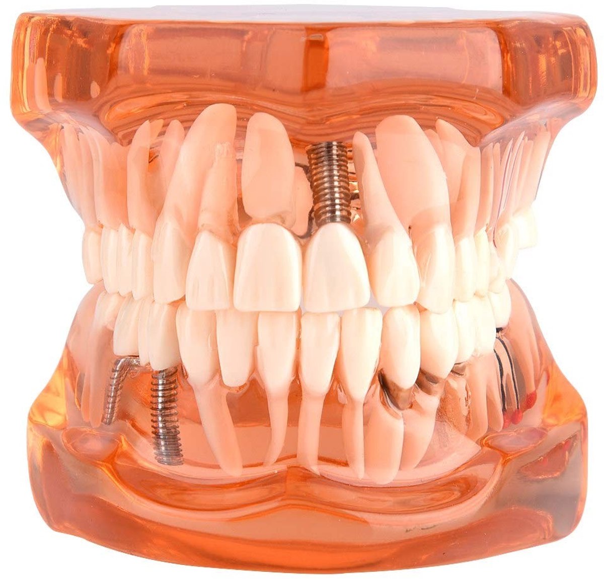 Dailygoods- Tand Implantatiemodel - Tandheelkundige Tools - Vaste Prothese - Demonstratiemodel - Onderwijs - Juridische Presentaties - Tandheelkundig Model