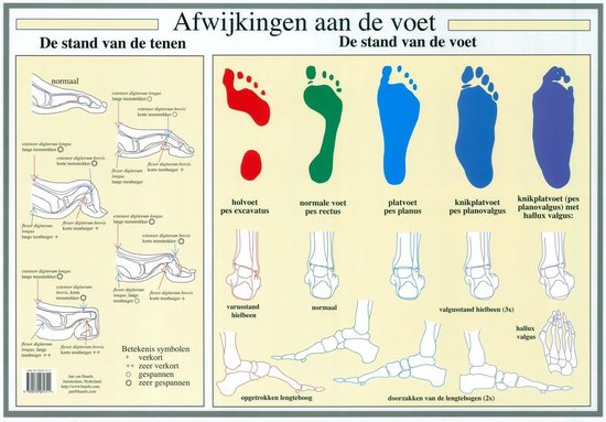 Le corps humain - Affiche d'anatomie des défauts du pied et du pied (néerlandais, plastifié, A2)