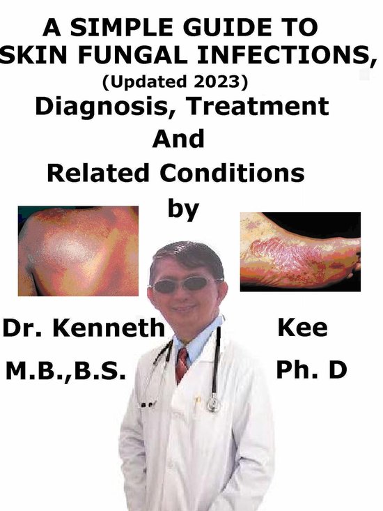 A Simple Guide to Skin Fungal Infections, (Updated 2023) Diagnosis