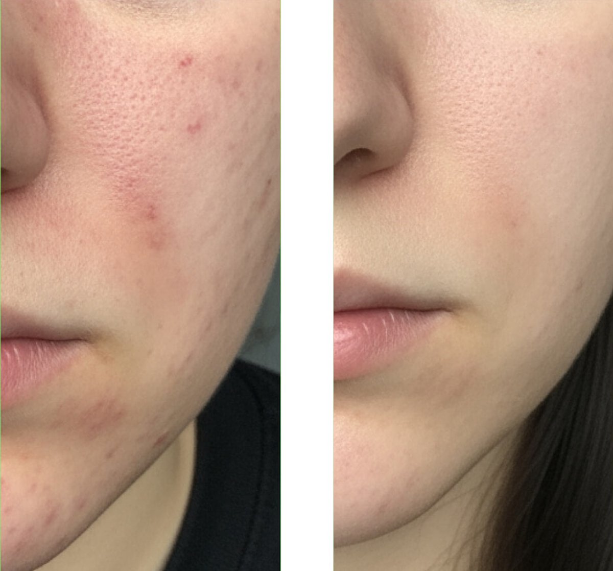 Australian Bodycare Salicylzuur Gezichtsreiniger tegen puistjes, mee-eters, onzuivere huid en verstopte poriën thumbnail 2