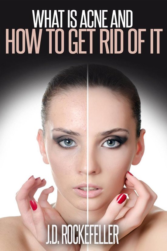 What is Acne and How to Get Rid of It (ebook), J.D. Rockefeller ...